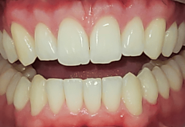 After Face - Stamford Dental Care